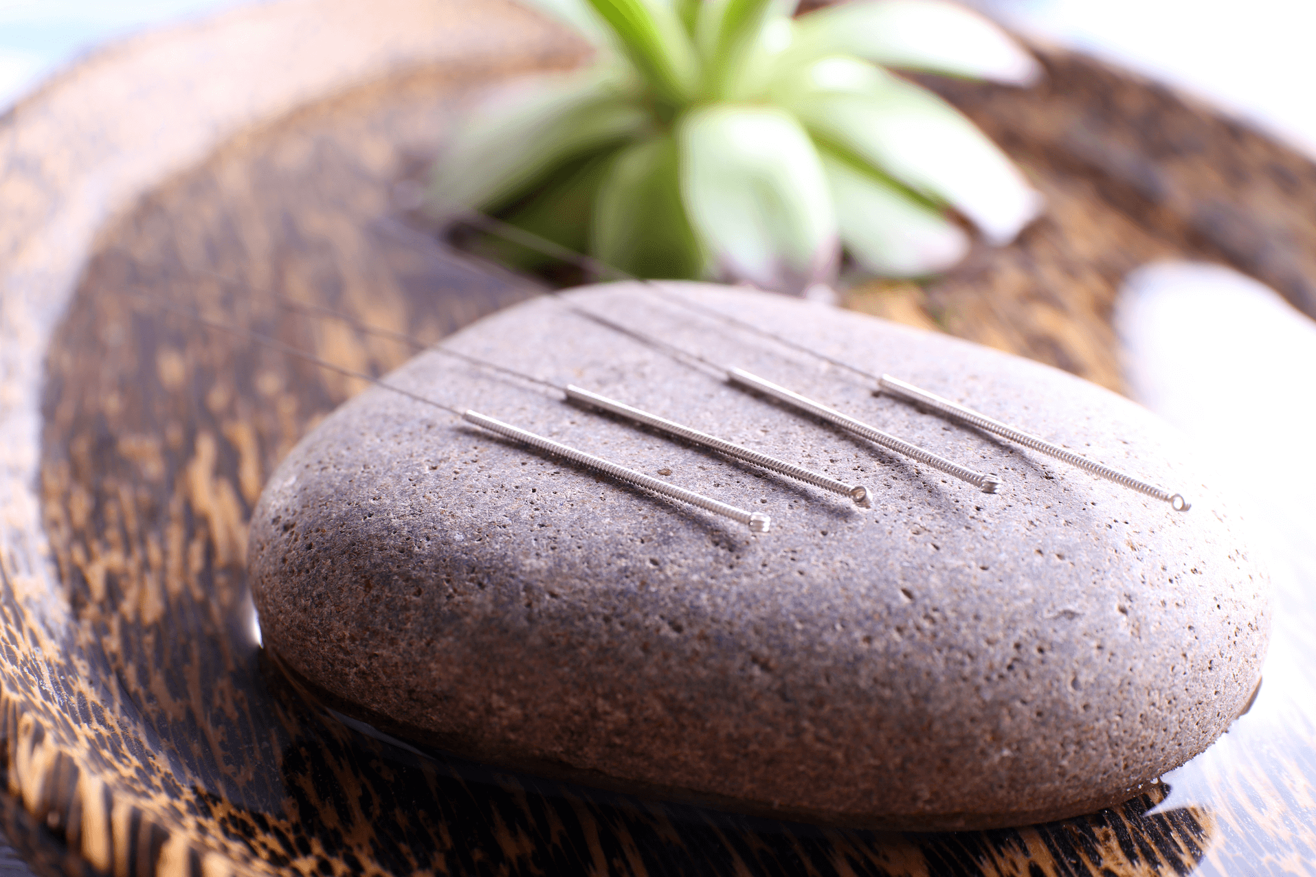 Acupuncture for Infertility