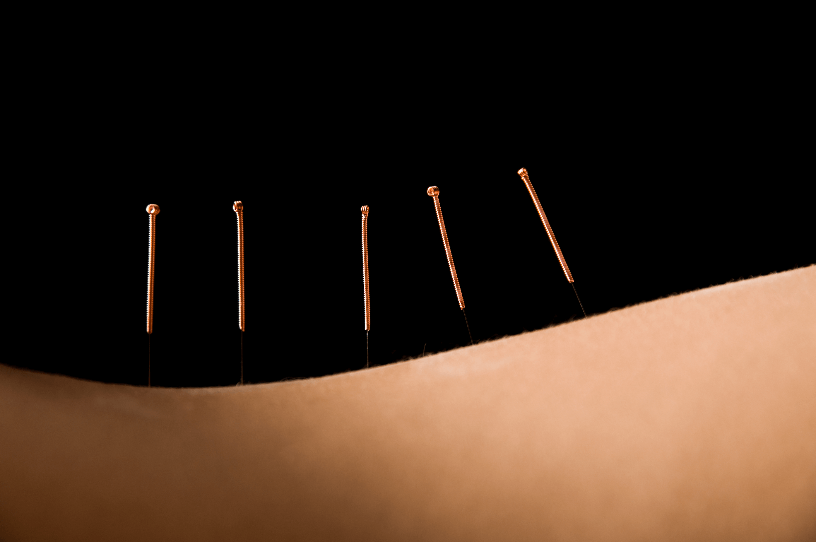 Acupuncture: Does it hurt?